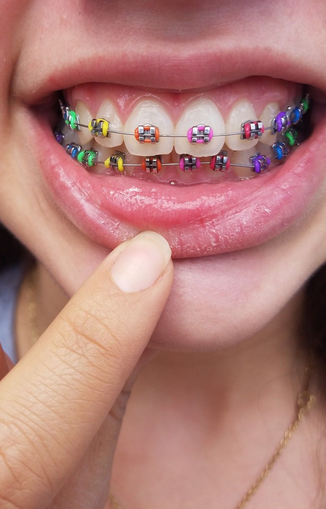Fashion braces